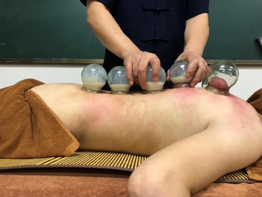 中醫(yī)可以通過拔罐辨別體質(zhì)